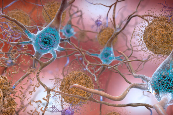 Alzheimer tedavisinde umut vadeden yeni bir ilaç geliştirildi.