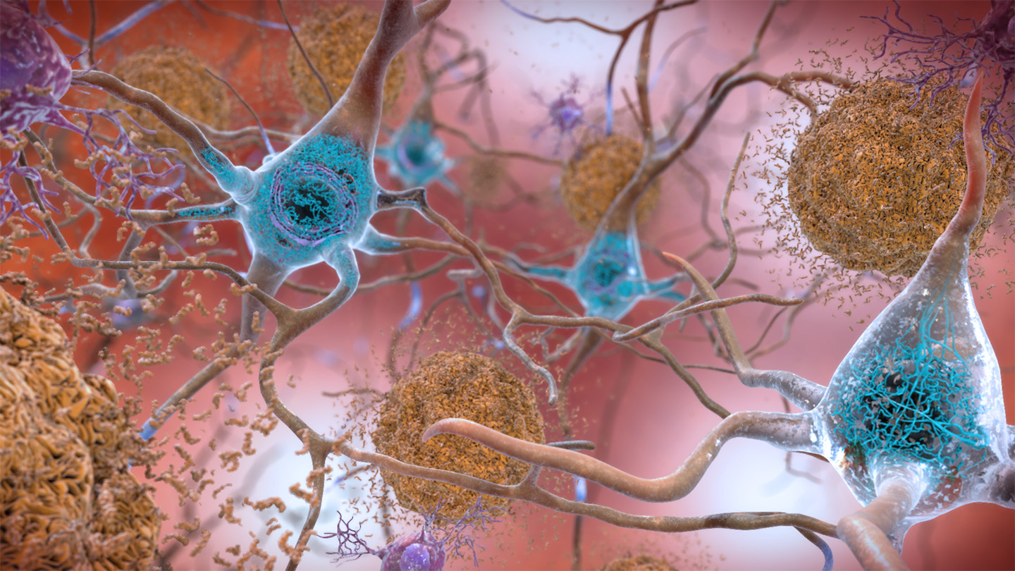 Alzheimer tedavisinde umut vadeden yeni bir ilaç geliştirildi.