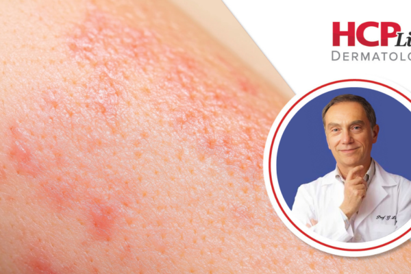 Vitiligoda Umut: Oral GP-SOD Tedavisinin Güvenliği, Dozajı ve Geleceği