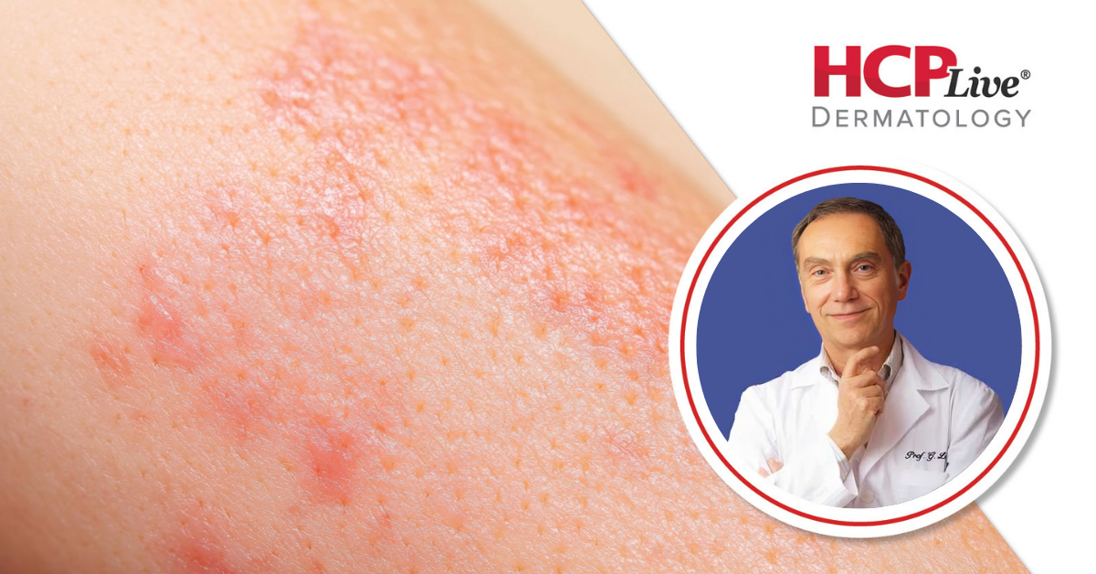 Vitiligoda Umut: Oral GP-SOD Tedavisinin Güvenliği, Dozajı ve Geleceği