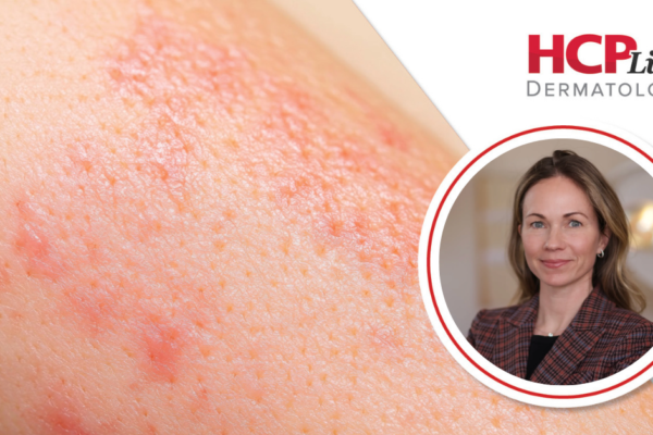 Güneş Kremi Hakkındaki Yanlış Bilgiler Neler? Dermatolog Kathleen Suozzi Açıklıyor.