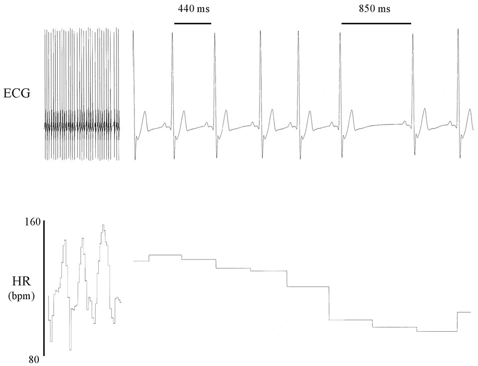 Hrv heart rate variability Nedir?