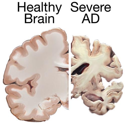 A healthy brain compared to a brain suffering from Alzheimer's Disease
