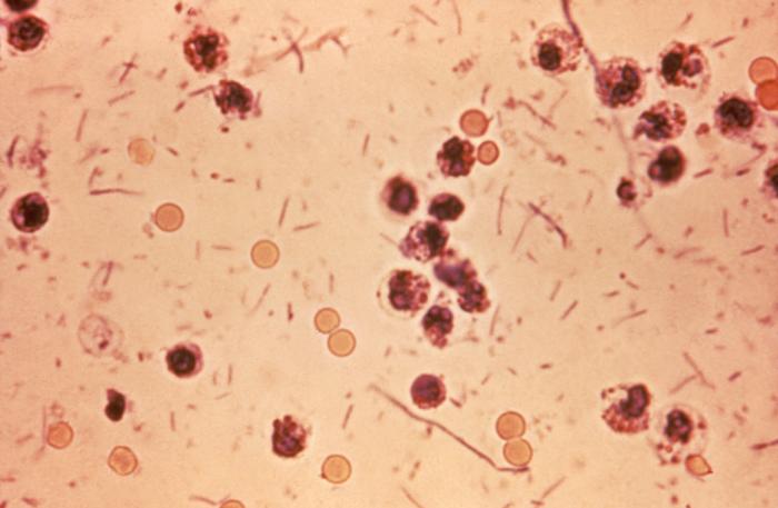Shigellosis vakasında gözlemlenen dışkı eksüdatlarının mikrografik görünümü.