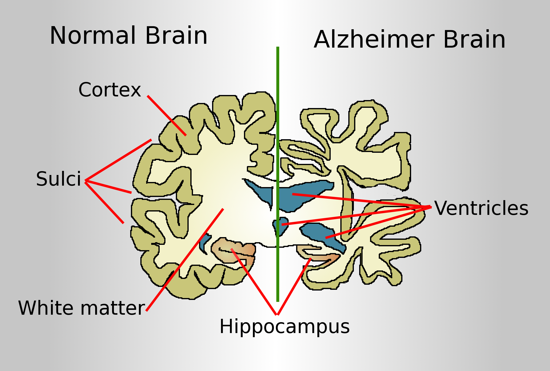 Sağlıklı bir beyin ile Alzheimer hastası beynindeki yapısal değişimleri karşılaştıran teknik illüstrasyon.