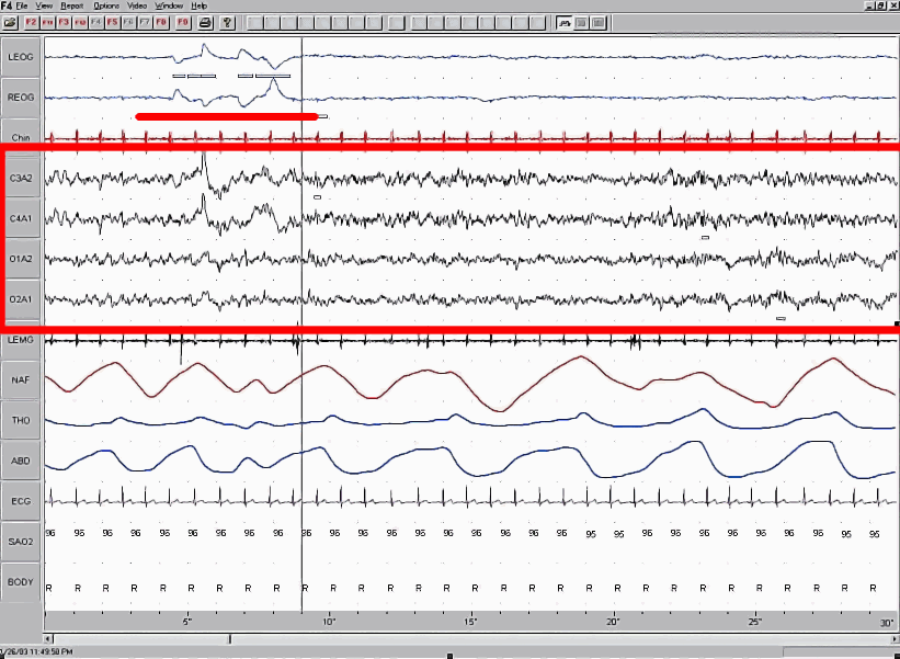 This is a screenshot of a polysomnographic record (30 seconds) representing Rapid Eye Movement Sl...