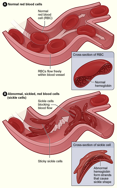 Sickle cell hastalığı illustration