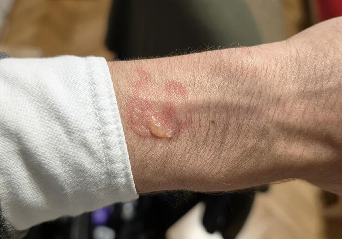 Alleged burn marks left by Galaxy Watch 5 Pro.